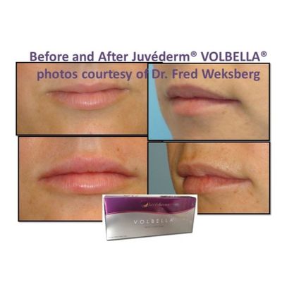 Hyaluronik Asit Juvederm Yüz Doldurucu Jeli Yumuşak ve Kusursuz Cilt