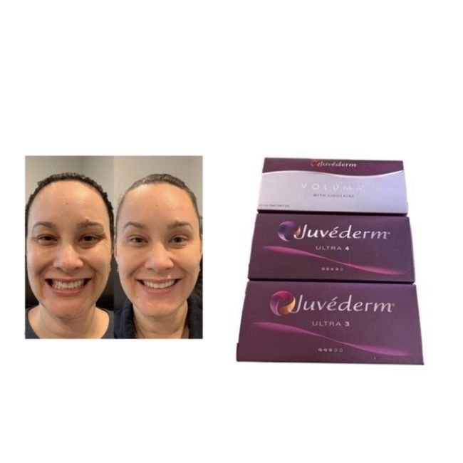 Çapraz Bağlı HA Juvederm Dermal Filler Ultra3 Ultra4 Hacim Depolama koşulları Dondurmaktan kaçının Yüz hacimini restore etmek için enjekte edilebilir jel