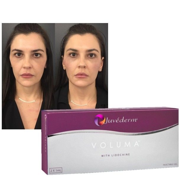 Hyaluronik Asit Dermal Dolgu Jeli Juvederm Dudaklar Yanaklar Gençleştirme Geliştirme Formülü