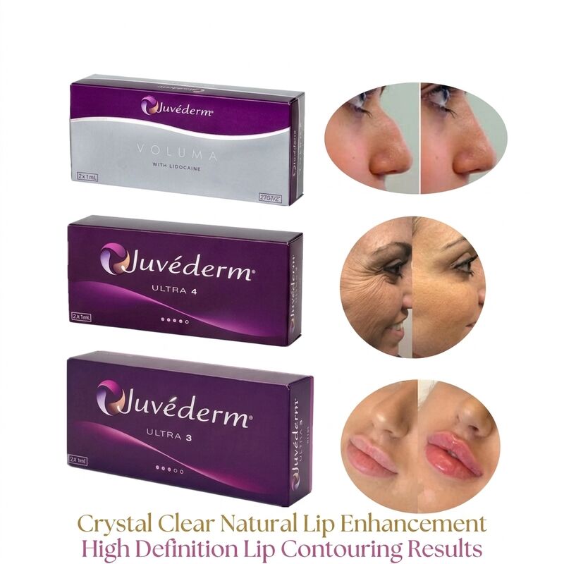 Şırınganın Hacmı 2 Kutu başına 1 ml Juvederm Hacmı Dolgucu Güvenlik Yüz Kontürü Hacmı Artıran Enjekte edilebilir Dermal Dolgucu